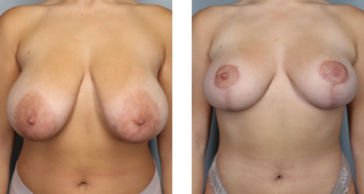 Breast Reduction before & after Patient 37