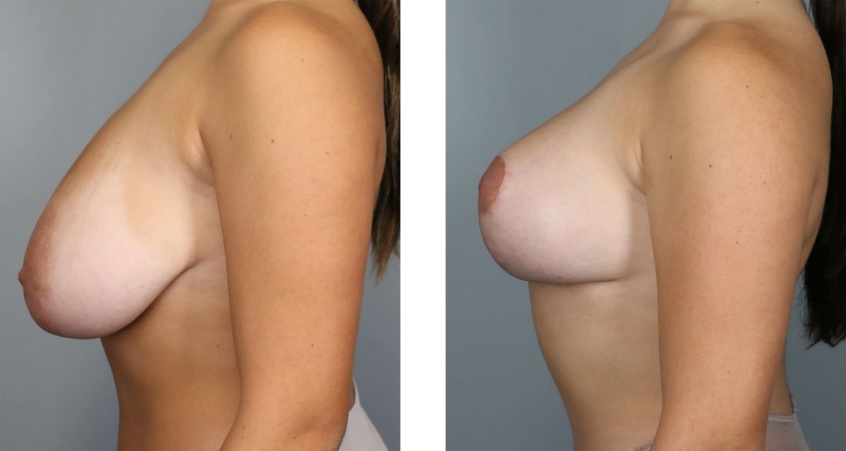 Breast Reduction before & after Patient 37