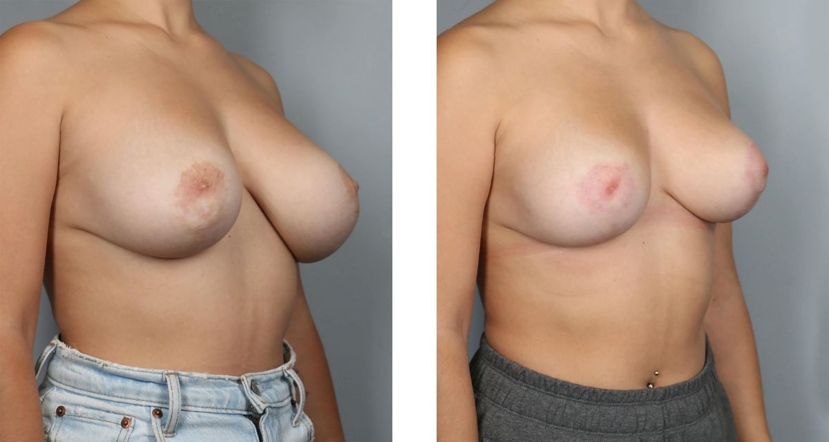 Breast Reduction before & after Patient 39