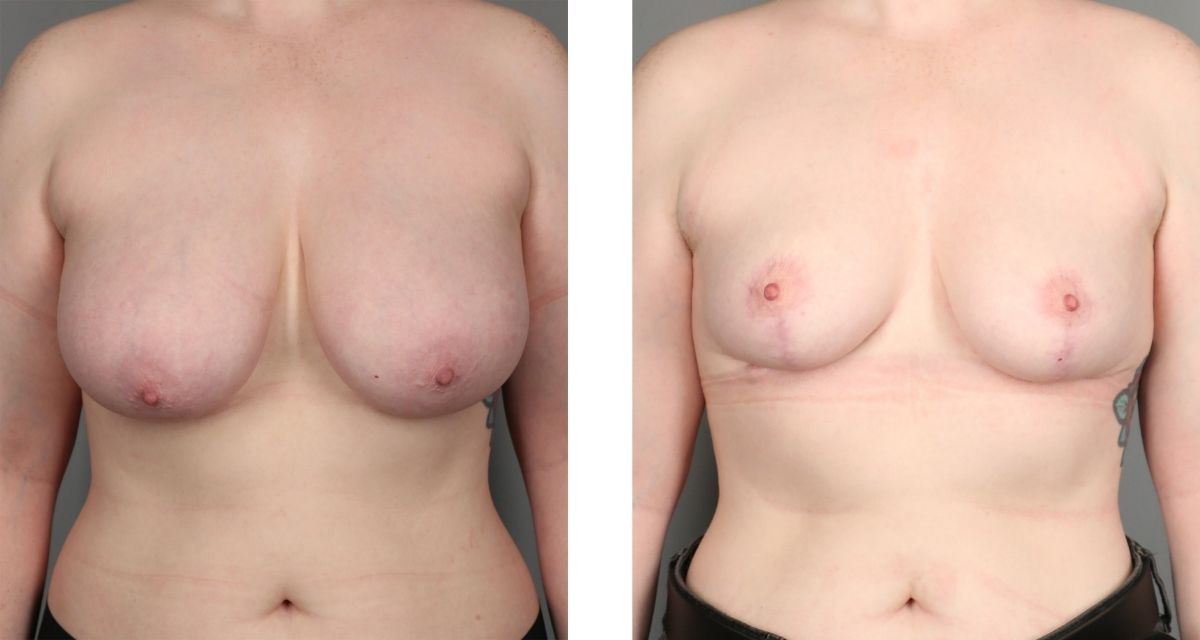 Breast Reduction before & after Patient 40