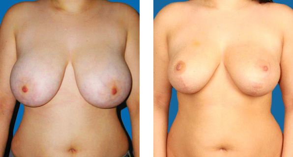 Breast Reduction before & after Patient 1