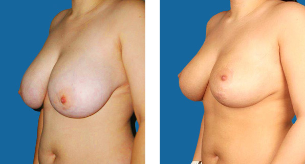 Breast Reduction before & after Patient 1