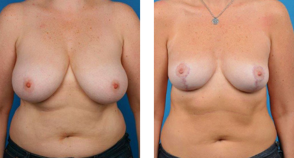 Vertical Incision Breast Reduction Before and After