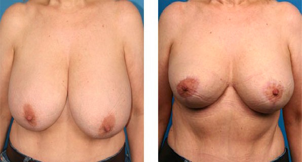 Wise Pattern Breast Reduction Before and After