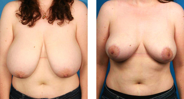 Breast Reduction and Lift Before and After