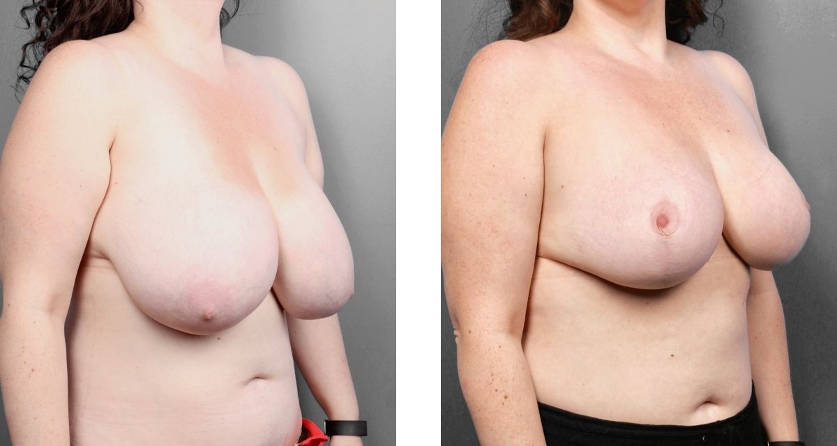 Breast Reduction before & after Patient 19