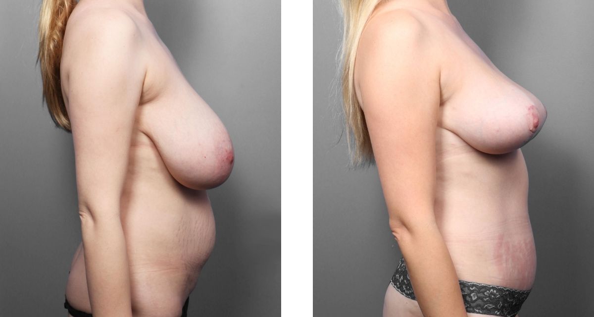 Breast Reduction before & after Patient 23