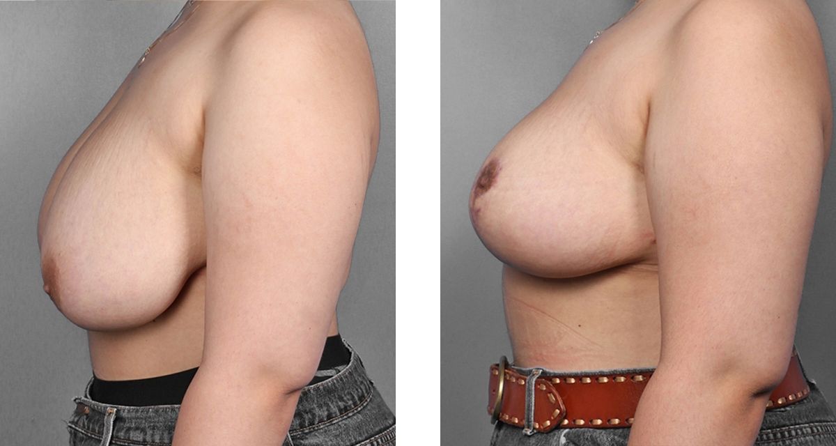 Breast Reduction before & after Patient 24