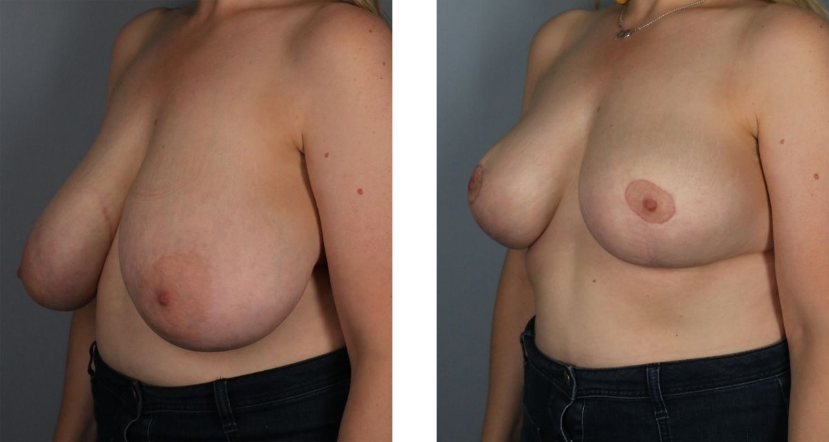 Breast Reduction before & after Patient 25