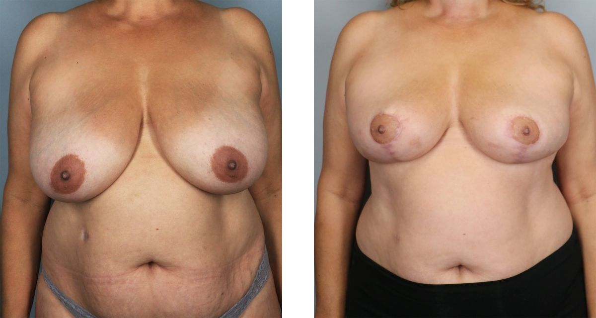 Breast Reduction before & after Patient 26