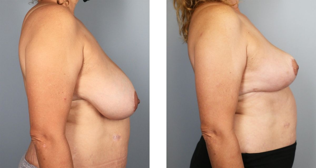 Breast Reduction before & after Patient 26