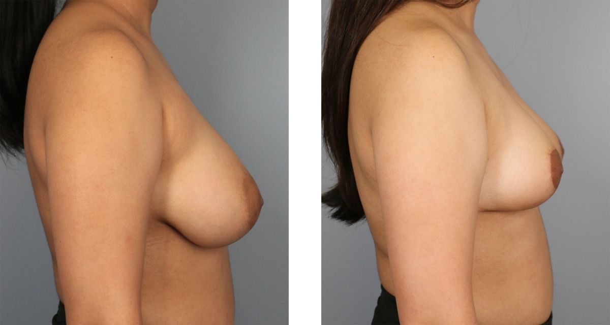 Breast Reduction before & after Patient 20