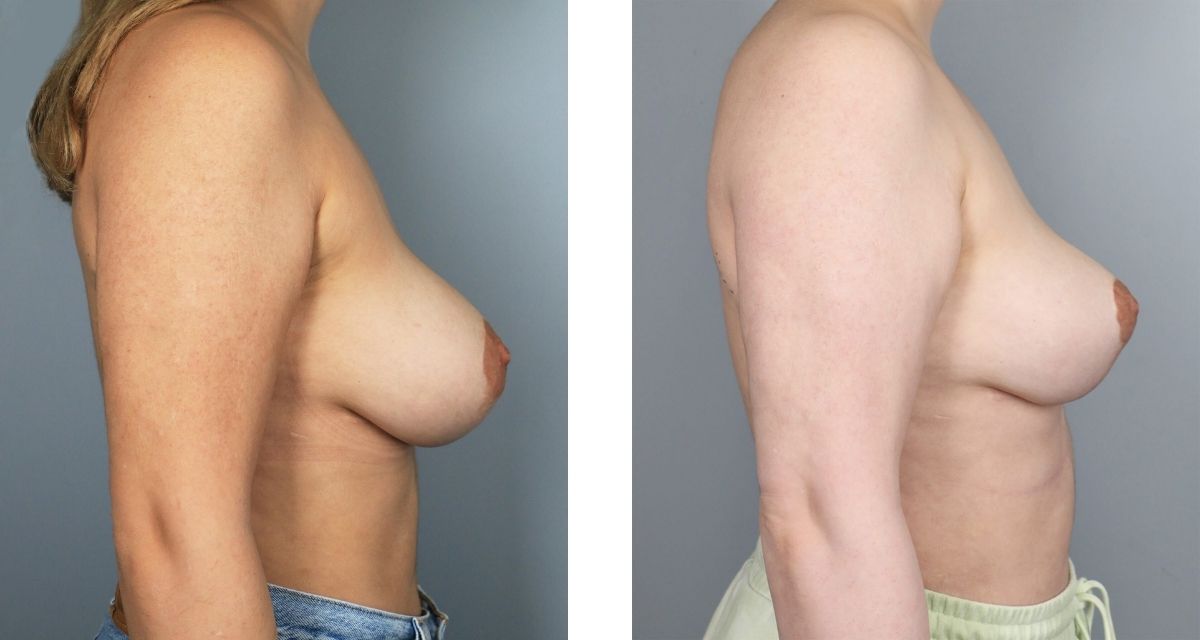 Breast Reduction before & after Patient 28