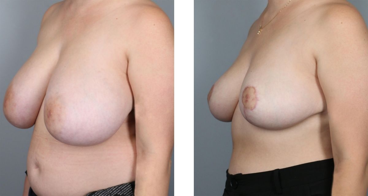 Breast Reduction before & after Patient 29