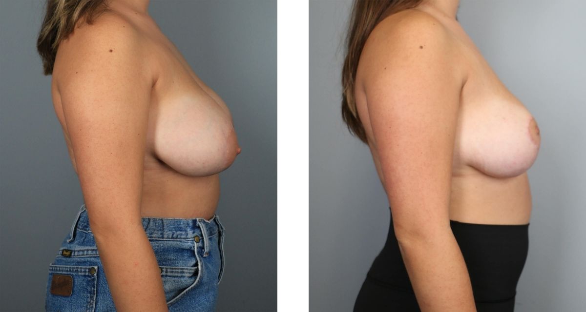 Breast Reduction before & after Patient 30