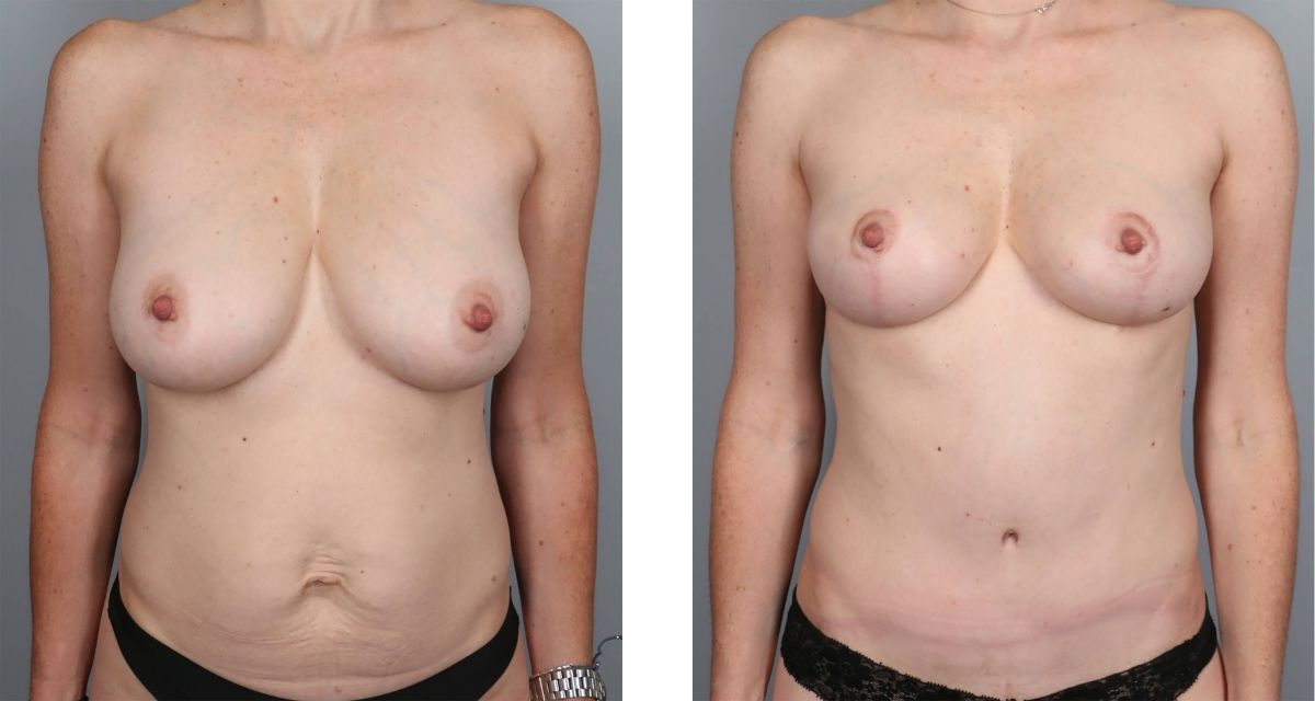 Breast Reduction before & after Patient 34