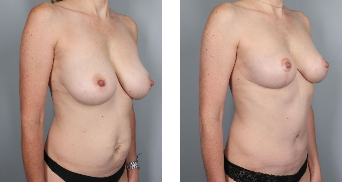 Breast Reduction before & after Patient 34