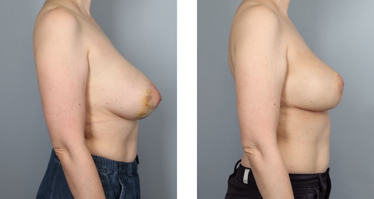 Breast Reduction before & after Patient 35