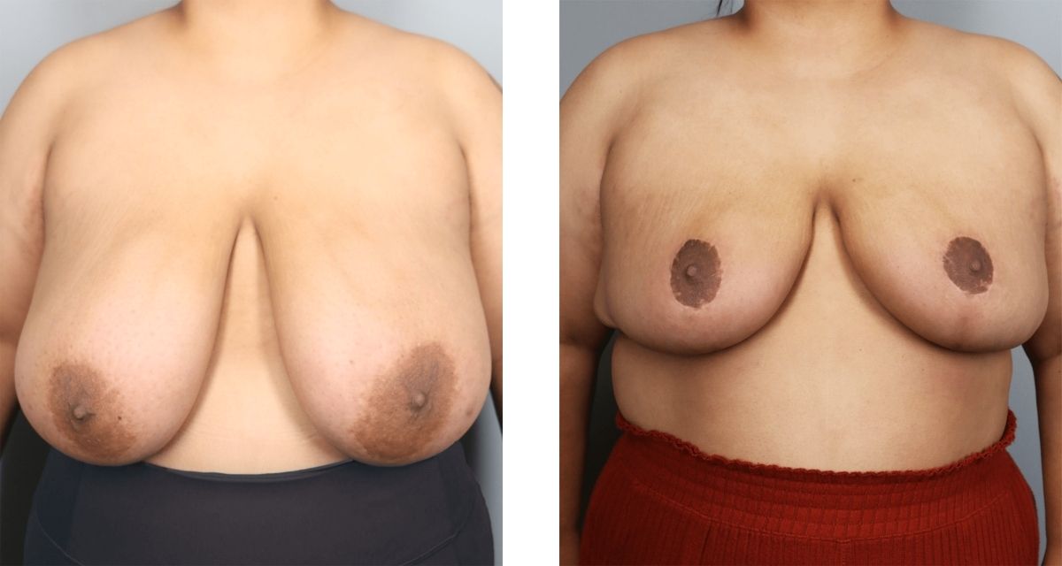 Breast Reduction before & after Patient 36